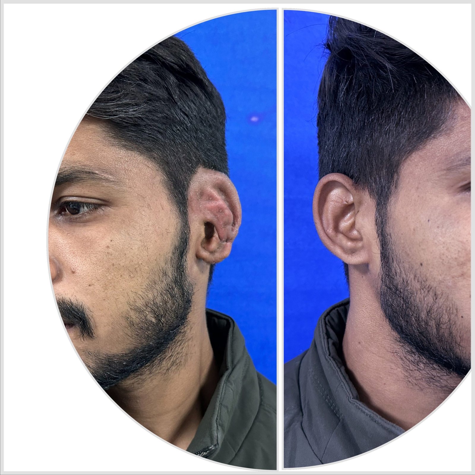 Expert ear reconstruction surgeon in Jaipur – Dr. Shubham Agarwal, specializing in microtia and anotia surgery.